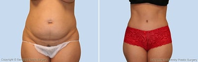 liposuction - liposuction