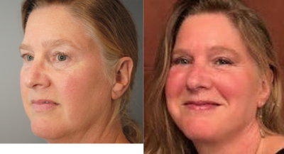 53 year old woman treated with ALMI - 53 year old woman treated with ALMI. Patient was looking for a way to soften some of the harsh changes aging had brought to her face and wanted to recapture the femininity she felt was losing. The procedure afforded her about 40 cc of regenerative biologic cellular material to transfer to her face and restore the shape and proportion she had lost over time. Accordingly, the jawline was defined, midface recreated and furrows and gulleys- like the nasolabial folds, chin crease and marionette lines- were improvedby the appropriate addition of volume. Her lips were also enhanced. Changes like this restored the concentric curves we associate with the female face and brought back the female proportion which highlights the midface and over rides the lower face. The added benefit of ALMI is that now the regenerative material placed will act to repair and regenerate aging cells. Patient also underwent upper and lower eyelid lift and liposuction of the neck.