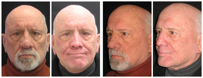 Dermabrasion - Dermabrasion