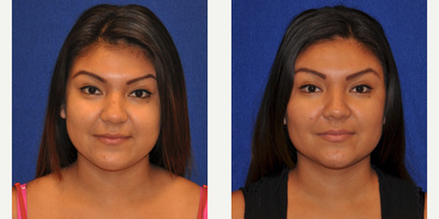 Buccal Fat Removal - Buccal Fat Removal