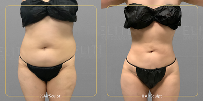 25-34 year old woman treated with AirSculpt - If you think it takes invasive, grueling liposuction to get these types of results, think again! This patient received our full ab procedure six months ago, seamlessly achieving dramatic curves and a toned stomach.