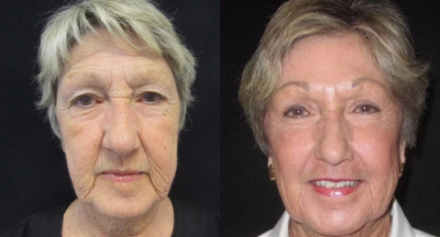 65-74 year old woman treated with MiXto Laser - This patient had multiple treatments including MiXto CO2 laser resurfacing to improve sun damage and tighten the skin, blepharoplasty of the upper lids, direct brow lift, Juvederm filler (Voluma XC for the midface, and Ultra XC for the lips), and micropigmentation of brows and eyeliner. She has radiant skin, more youthful eyelids, improved fullness of the cheeks and marionette lines, and natural enhancement and definition of the brows and eyelids.