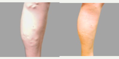 35-44 year old woman treated with VenaSeal - Treatment for chronic venous insufficiency.