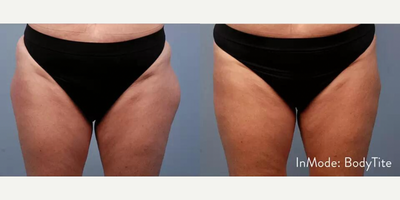 Woman treated with BodyTite, Emsculpt - Woman treated with BodyTite, Emsculpt