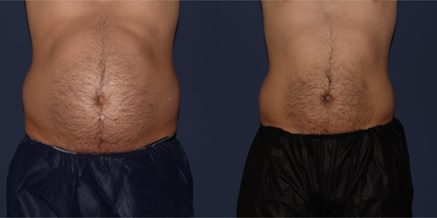 35-44 year old man treated with UltraShape Power - Male patient treated 3 times with UltraShape Power, each treatment spaced 2 weeks apart. Final photograph 12 weeks after 3rd treatment.