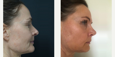 45-54 year old woman treated with Rhinoplasty - Rhinoplasty & Septoplasty surgery performed by Ozge Ergun, MD  - 36 days post-operative