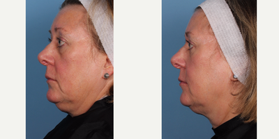 55-64 year old woman treated with CoolSculpting - CoolMini administered to reduce chin fat.