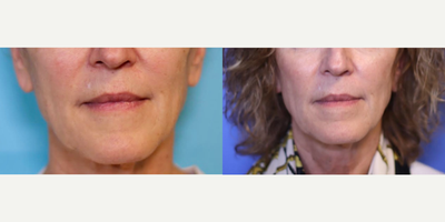 65-74 year old woman treated with Morpheus 8 - A 65-74 year old woman had a Morpheus 8 treatment