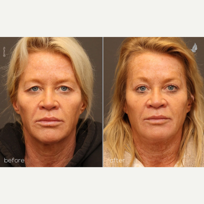 Endoscopic brow lift and upper lid lift (blepharoplasty) - 50 yo patient who is 3 months out from an endoscopic brow lift and upper blepharoplasty