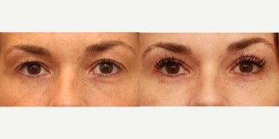 Blepharoplasty - Upper Eyelid Lift - 41 year old female who underwent an upper blepharoplasty in the office under local anesthetic