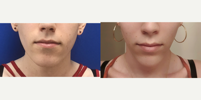 Patient treated with Chin Implant - Chin Implant (Central) with Reduction and Contour - 25 to 34 year-old female patient is 9 months post-op from Facial Feminization surgery. Her procedures included: Placement of Tissue Expander, Septorhinoplasty (Closed) with Cartilage Grafts; Cheek Implants; Chin Implant (Central) with Reduction and Contour; Soft Tissue to Nasolabial Folds; Subnasal Lip Lift with Fat Augmentation to Lips; Thyroid Cartilage Shave and Voice Feminization and Hairline Lowering, Hairline Forehead Lift and Orbital Bony Contour.