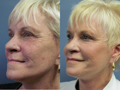 Chemical Blue Peel &Lite Lift - 	Obagi Blue Peel applied after 63y/o had The Lite Lift. The peel reduces superficial winkles and acne scarring. Helps to maintain healthy skin renewal .