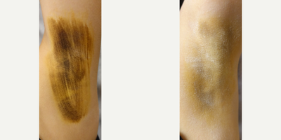 25-34 year old woman treated with miraDry - Before each miraDry treatment an iodine solution is applied to the skin and allowed to air-dry. Once dry the area is dusted with cornstarch or potato flour. When sweat reaches the surface of the skin the starch and iodine combine causing a dramatic color change (yellow -&gt; dark blue) allowing sweat production to be actively visualized. These photos demonstrate the level of sweat production at the initial consultation and at the 2 week follow up appointment post 1 treatment with miraDry. Sometimes a 2nd treatment is needed.