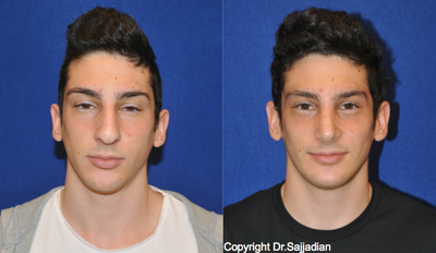 Chin Implant - Chin Implant