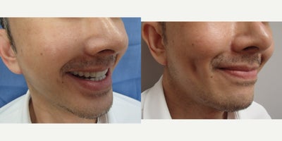 45-54 year old man treated with Dimple Surgery - This patient underwent our customized Timeless Dimple (dimpleplasty) to enhance and complement their individual facial expression and features.