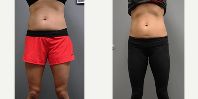 35yr old female 3 sessions of UltraShape Power and VelaShape III. - 35yr old female 3 sessions of UltraShape Power and VelaShape III. Photos are from 2 weeks after final session. Sessions were 2 weeks apart.