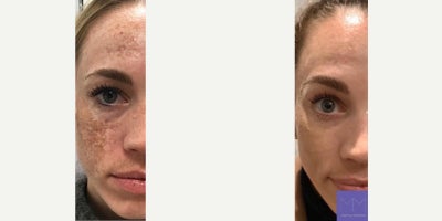 Woman treated with Laser Resurfacing, Skin Rejuvenation - This is one of our patients melasma journeys from the past 14 months. Patients with hyperpigmentation need to be truly committed to their treatments on a consistent basis in order to achieve the best results. This patient has been treated with a series of lasers at MM SkinCare Genius MM Revive & LED mmsphere, hydrafacial and TCA 30% + Jessners peels at intervals averaging 4 months apart. With or without melasma, we think shes a stunner!