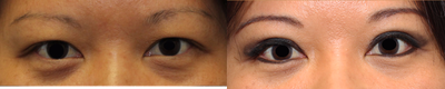 Double eyelid surgery - Double eyelid surgery (incisional method) was performed to enhance the upper eyelid crease