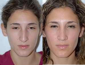Woman treated with Asian Rhinoplasty - Woman treated with Asian Rhinoplasty
