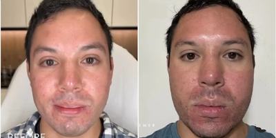 Man treated with TCA Peel, Fraxel Laser - Man treated with TCA Peel, Fraxel Laser