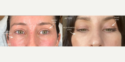 Woman treated with PlasmaPen - Woman treated with PlasmaPen