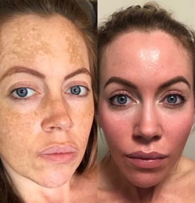 25-34 year old woman treated with Obagi Nu-Derm - Client suffered with melasma (hormonal pigmentation). Photo credited as 19 weeks into her treatment plan. Fantastic result from the Obagi Nu-Derm Skin Transformation kit.
