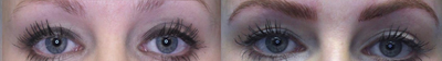 Microblading  by Heidi Carney - Cosmetic tattooing is a procedure that tattoos pigment onto areas of the face that mimics the appearance of makeup. Cosmetic tattoos are used by people who have sensitivity or allergies to traditional cosmetics, people with difficulty seeing, and patients who are unable to apply makeup due to conditions like arthritis or Parkinsons disease. In addition, it is also beneficial for those who do not have facial hair due to allergies, hair pulling, or aging and genetics. After the areas of the face receive cosmetic tattoos, the makeup becomes semi-permanent and will not wash off from water, cleansers, or sweat. Cosmetic Tattooing is usually applied to the eyebrows, upper and lower eyelashes, and the lips.