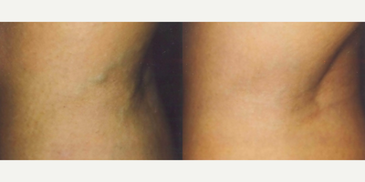 Woman treated with Pulsed Dye Laser - Woman treated with Pulsed Dye Laser