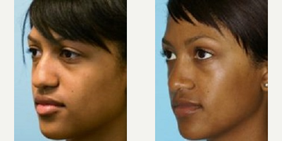  Treated with Rhinoplasty - This patient from Temecula wanted to soften the appearance of her nose and make it look more elegant. She didnt want to make her nose too small and wanted to maintain some of the ethnic characteristics of her face.