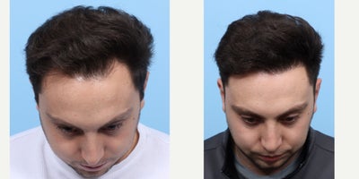 25-34 year old man treated with FUE Hair Transplant, Hair Transplant, Hair Loss Treatment, PRP for Hair Loss, PRP Injections - Dr. Wise performed an FUE hair transplant on this patient to restore his hairline. During the procedure he placed 2,250 grafts in zone 1 of the scalp and did one treatment of PRP injections.