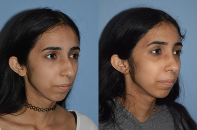 18-24 year old woman treated with Rhinoplasty - 18-24 year old woman treated with Rhinoplasty