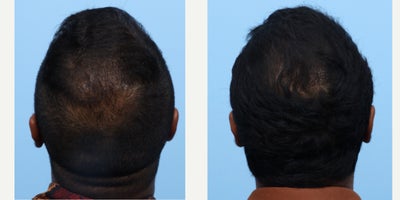 35-44 year old man treated with FUE Hair Transplant, Hair Transplant, Hair Loss Treatment, PRP for Hair Loss, PRP Injections - This patient had an FUE with another physician in the past and was pleased with results but still had scarcity in his crown and hairline. Dr. Wise performed an FUE hair transplant and PRP to achieve these results. He will continue to see growth up to one year.