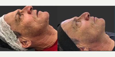 Man treated with Genius RF, LaseMD - Man treated with Genius RF, LaseMD
