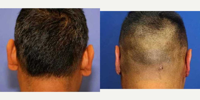 Ear Surgery - Dr.Katzen performs ear pinning or otoplasty. This is a patient in his mid 40s who was concerned about the appearance of his ears. Ever since a child, he had ears that stuck out. As a child, he was teased constantly at school about the shape and size of his ears. He told me he was often called Dumbo earsear