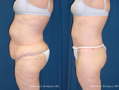 Body Lift - Body lift