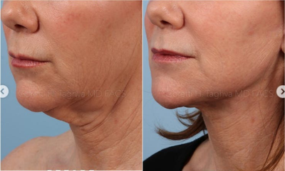 Woman treated with Vivace - This beautiful patient is 3 months out from her Vivace. She was concerned about the loss of definition of her jawline and the overall laxity in her face and neck region.