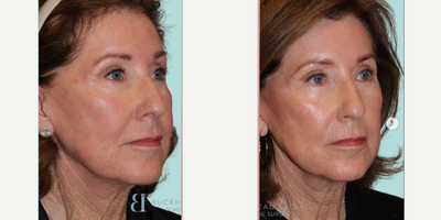 Woman treated with Emface - She used 4 treatments of Emface, with each treatment spaced 4 weeks apart. Now, keep in mind that the result you're seeing right now is just one month after the treatment. But, typically, you can expect to see the full results in about 3 months.Just notice the texture change in her skin as well as the lift in her cheekbone and midface.