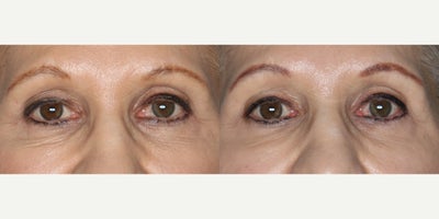65-74 year old woman treated with Skintyte - SkinTyte BBL for Eyes - 6 treatments, 2 weeks apart