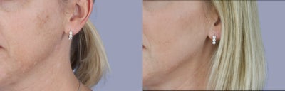 45-54 year old woman treated with Tribella - 45-54 year old woman treated with VenusTribella