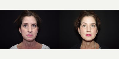 45-54 year old woman treated with Bellafill - 54 year old female received 2 syringes of Bellafill to the perioral & infraorbicular, as well as Perlane and CO2 resurfacing; photo's depict the patient's results 11 weeks post-op.