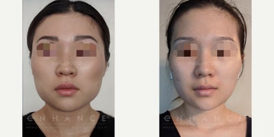 18-24 year old woman treated with Jaw Reduction - This patient benefited from shaving the jaw bone to narrow both the frontal view as well as rounding the square bone edge on the side view. Buccal fat was easily accessible and removed through the same mouth incision. Recovery time 8 days. This procedure is quite difficult for a surgeon to master due to the tight angles involved.