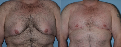 25-34 year old woman treated with Gynecomastia Surgery - Male breast reduction with free nipple grafts, 2 months postop