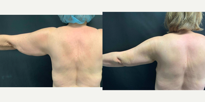 65-74 year old woman treated with Arm Lift - 65-74 year old woman treated with Arm Lift, shown 3 months post op.