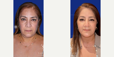 Woman treated with Neck Lift - Woman treated with Neck Lift