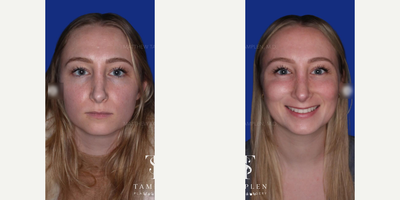 Woman treated with Revision Rhinoplasty - Woman treated with Revision Rhinoplasty