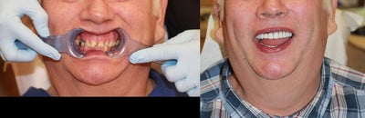 All-on-4 Dental Implants - The All-on-4 is the modern solution for all missing teeth. This treatment concept replaces your missing teeth with a Full Dental Bridge, No Palate, No Excess Material, Not Removable, and supported by only Four Specialty Dental Implants, with two of the Implants placed at precise angles. With less implants needed, overall treatment time is reduced. The unique All-on-4 solution also ensures greater stability in the bone, reducing the need for bone graft surgery to increase bone volume. Your teeth will look, feel and are brushed much like natural teeth, and you can lead a normal life immediately after a 1 Day surgery. Studies indicate that Patients receive 90-95% chewing ability. Your quality of life is improved and you can start enjoying your favorite foods again.