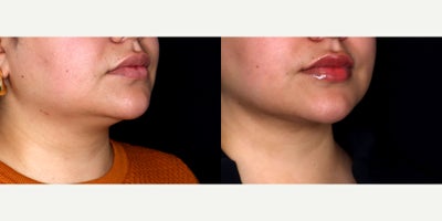 28 year old woman treated with Liposuction, chin Fat Transfer, PrecisionTx - 28 year old female treated with liposuction to the submental neck (double chin) and fat transfer to chin. Photos depict before and 3 weeks after surgery