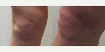 Woman treated with BodyTite - BodyTite to the knee