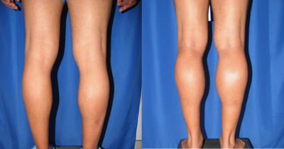 Treated with Calf Implant - Treated with Calf Implant