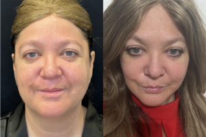 Woman treated with Buccal Fat Removal - Woman treated with Buccal Fat Removal